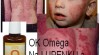 ATOPICKÝ ekzém a LUPENKA 404609_t.jpg