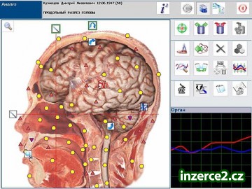 1A - špičkové vyšetření NLS diagnostikou METATRON Hunter_1 111924_1.jpg