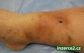 BÉRCOVÉ VŘEDY A OK GEL_1 184305_1.jpg