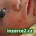 EKZÉMY, LUPÉNKA, BRADAVICE, JIZVY.._1 187279_1.jpg
