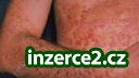 EKZÉMY, LUPÉNKA, BRADAVICE, JIZVY.._2 187279_2.jpg