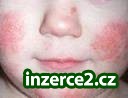 Zbavte se ekzému i vy ! Bez chemie a kortikoidů, a trvale !_1 233469_1.jpg