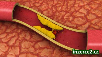 Strašák jménem CHOLESTEROL_1 396452_1.jpg