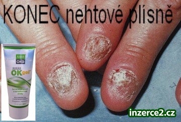 Nevíte jak na NEHTOVOU PLÍSEŇ? možnost 40% slevy_1 418517_1.jpg