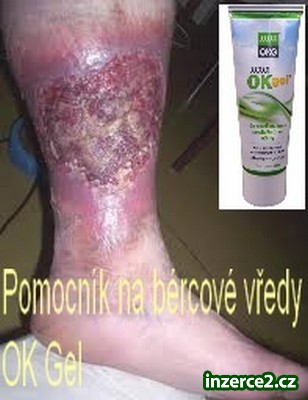 Nevíte jak na BÉRCOVÉ VŘEDY?_1 423490_1.jpg