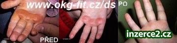 OK Gel na popáleniny i ekzémy_1 65532_1.jpg