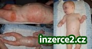 Vím jak na atopický ekzém.._1 69085_1.jpg